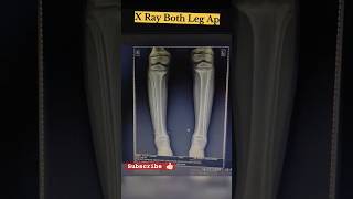 x ray both leg ap  radiology  xray  viral youtubeshorts trending xray anatomy youtube [upl. by Eiramait865]