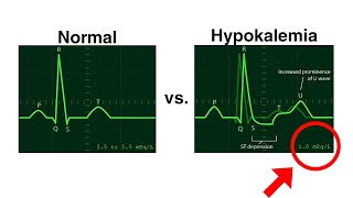 Hypokalemia ECG  Normal vs Hypokalemia  ECG changes in Hypokalemia ecg hypokalemia cardiology [upl. by Aikemal]