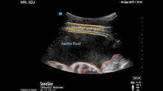 Ultrasound guided drainage of Ascites [upl. by Pond]