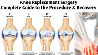 Knee Replacement Surgery Complete Guide to the Procedure and Recovery [upl. by Alieka119]