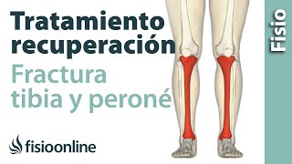 Fractura Tibia y Perone  Rehabilitacion completa [upl. by Drahser]