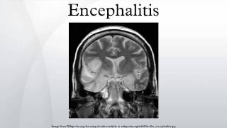 Encephalitis [upl. by Eads]