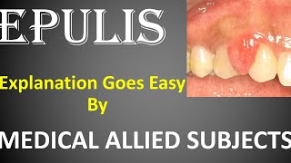 epulis gumstopic epulisfissuratum epulismeaning epulisgraviderum epulissurgery cyst [upl. by Ayeki766]