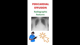 ✅ How To Diagnose Pericardial Effusion shorts xray [upl. by Letnwahs]