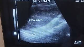 splenomegly in ultra sound [upl. by Locke]