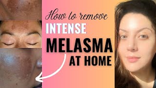 How to Remove Melasma from Face Permanently at Home I Melasma Removal Treatment [upl. by Korb]