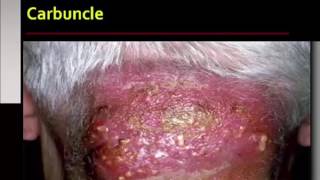 Bacterial Infections of the Skin [upl. by Ystap]