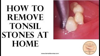 How to remove tonsil stones at home  Tonsil stone removal [upl. by Devaj161]