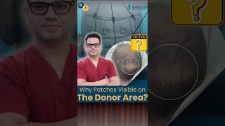 Shocking Why Donor Area Hair Loss Patches Are Exposed After Hair Transplant  shorts [upl. by Sined693]