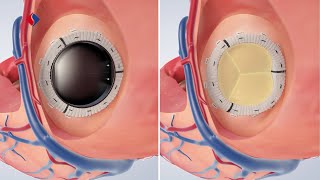 Mitralklappeninsuffizienz OP  Medizinische Animation [upl. by Nirihs]