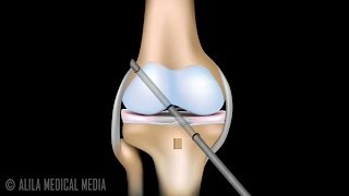 ACL Reconstruction Surgery Animation [upl. by Rhetta]