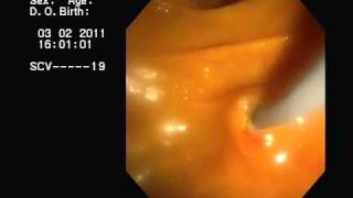 CPRE y drenaje de Colangitis Aguda ERCP acute cholangitis [upl. by Anitneuq]