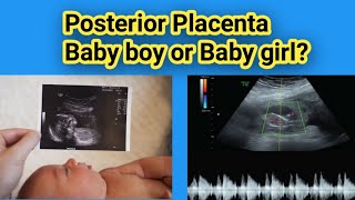 Posterior placenta Baby boy or Baby Girl Gender Prediction Radiology vibes [upl. by Esylle]