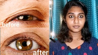 Eyelid Lifting exercise  Double chin sagging exercise  എളുപ്പത്തിൽ ചെയ്യാം [upl. by Aienahs645]