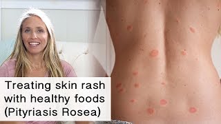 Treating skin rash and inflammation with healthy foods Pityriasis Rosea [upl. by Latreece]