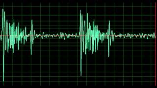 Hypertrophic Cardiomyopathy normal speed [upl. by Eirual]