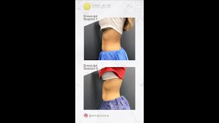 IG kaebaes 6 sessions of Emsculpt Abs Journey with Nurse Emily IG emjections [upl. by Pena34]