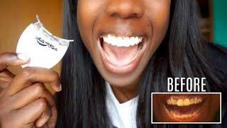 My Teeth Transformation  Dental Bridge Experience  Maintenance [upl. by Berny]