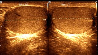 Normal Testis  Ultrasound cases 513 of 2000 [upl. by Mathews215]