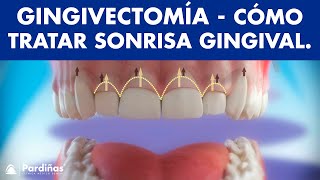 Gingivectomía  Tratamiento de la sonrisa gingival o exceso de encía © [upl. by Ainet]