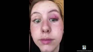 Ultimate Pimple Popping 2024 Epic Pimple Removals [upl. by Doniv]