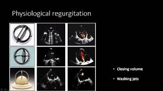 ECHO evaluation of Prosthetic Valves MITRAL PHILIPS Webinar [upl. by Perr]