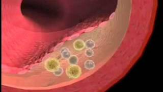 CRP Inflammation and Heart Disease [upl. by Sukhum]