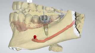 Digital Implant Dentistry [upl. by Ainotahs366]