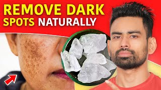 How to Remove Dark Spots and Get Clear Skin Pigmentation Dark Underarms Acne scars amp more [upl. by Elvina365]