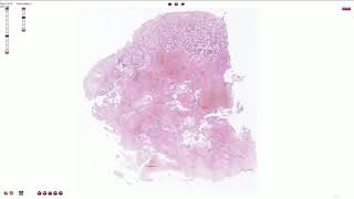 Choriocarcinoma  Histopathology [upl. by Elvia]