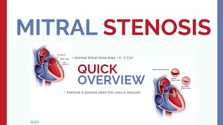 Mitral Stenosis  Overview amp Revise [upl. by Datnow]