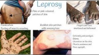 Leprosy  leprosy treatment  Leprosy pathology  hensens disease  leprosy disease [upl. by Philis]