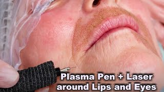 Plasma Pen Fibroblast treatment in combination with Laser for wrinkles around lips and eyelids [upl. by Cotterell]