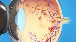 Diabetic Laser Macular Edema [upl. by Adelaja547]