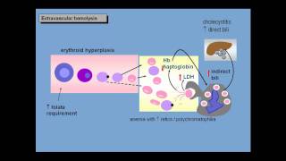 Anemia of increased red cell destruction loss [upl. by Anyd76]