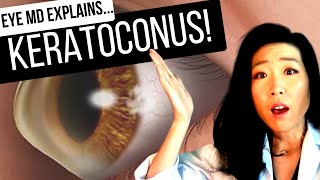 KERATOCONUS and What To Do About It  All About Cornea Crosslinking [upl. by Ainit]