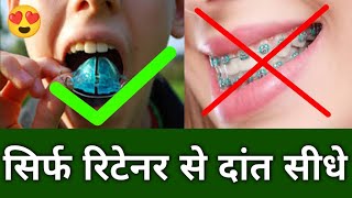 Straighten teeth with only Retainers  सिर्फ रिटेनर से दांत सीधे [upl. by Jere358]