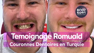 SOINS DENTAIRES  🦷 Témoignage Romuald  24 couronnes dentaires Emax  extractions  BODYEXPERT [upl. by Delija]