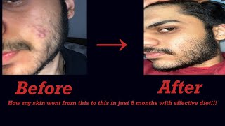 Diet tips for acne prone skinHormonal acnecystic acneResults in just 6 months [upl. by Attalanta973]