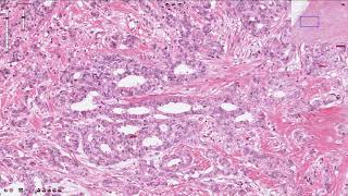 Ductal Carcinoma  Breast [upl. by Erolyat]