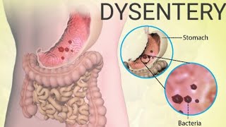 What is Dysentery Bacillary dysentery Amoebic dysentery DysenterysymptomsDiagnosis Treatment [upl. by Ativla984]