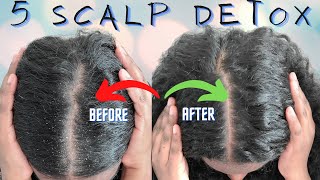 5 DIY DETOX amp SCALP EXFOLIATION FOR HEALTHY HAIR GROWTH How to Fix An Itchy Flaky Dry Scalp [upl. by Coraline]