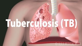 Tuberculosis TB Progression of the Disease Latent and Active Infections [upl. by Dasteel]