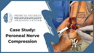 Case Study Peroneal Nerve Compression [upl. by Brennen956]