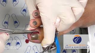 OCfeetcom  Ingrown Big Toenail Surgery in HD [upl. by Teri]