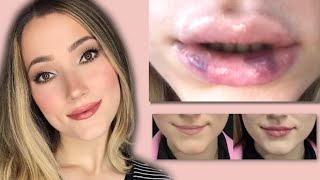 FIRST TIME LIP FILLER VLOG AND EXPERIENCE [upl. by Bohman]