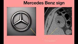 Mercedes Benz sign  Radiology spotter Medicine spotter  OSCE  MDDNBMBBS [upl. by Ime]