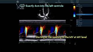 〖Echocardiography〗 Color MMode flow propagation measurement  diastolic function 🫀 [upl. by Lednyc33]