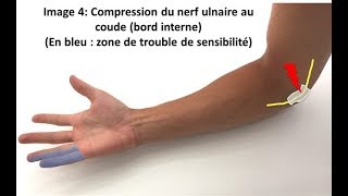 Nerf cubitale ulnaire soulagez sa compression naturellement [upl. by Silsby]