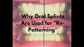 Why Oral Splints Are Sometimes Used During PRI Programs [upl. by Thistle]